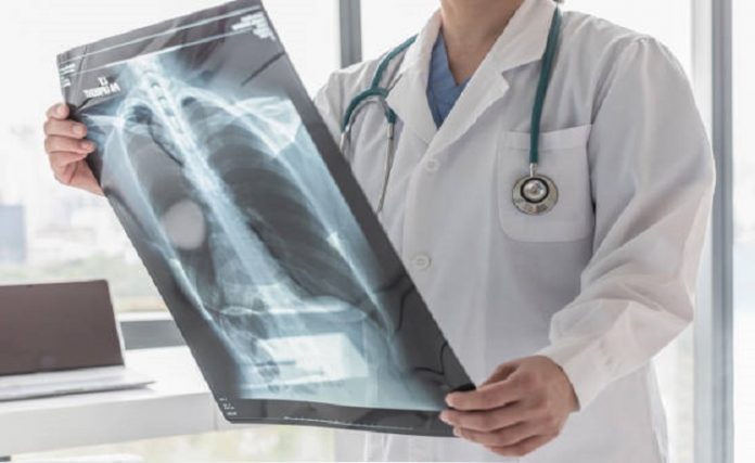 istockphoto-Especialistas Tuberculosis Especialistas Tuberculosis