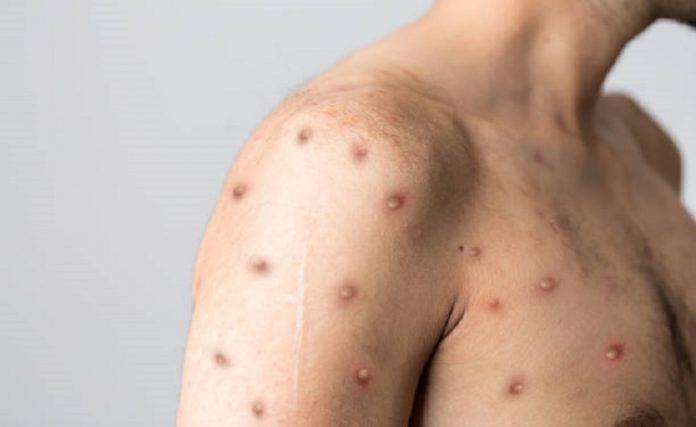 viruela mono pandemia Monkeypox viruela mono pandemia