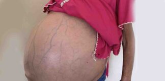 paciente tumor gigante residentes detenidos HUM