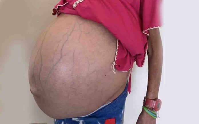 residentes detenidos HUM paciente tumor gigante residentes detenidos HUM